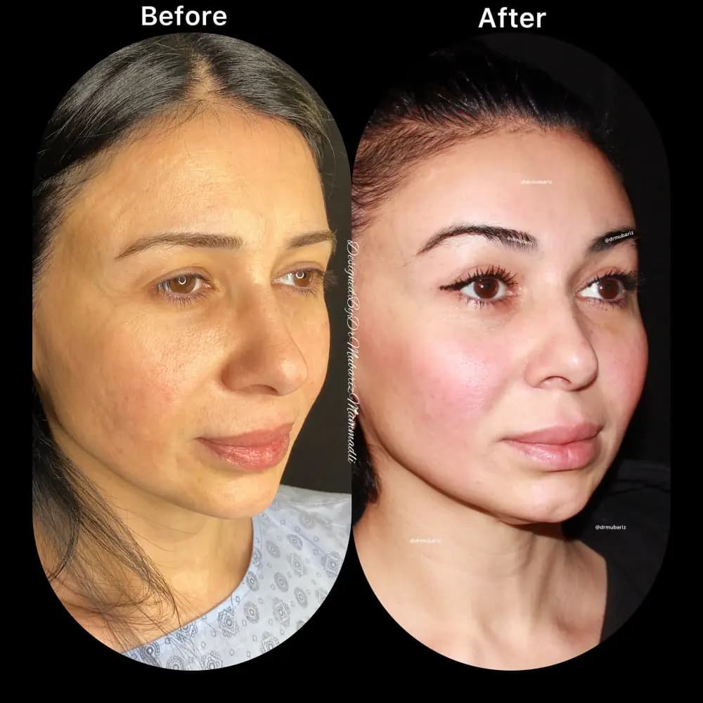 Rezultat inainte si dupa pentru echilibrarea profilului facial