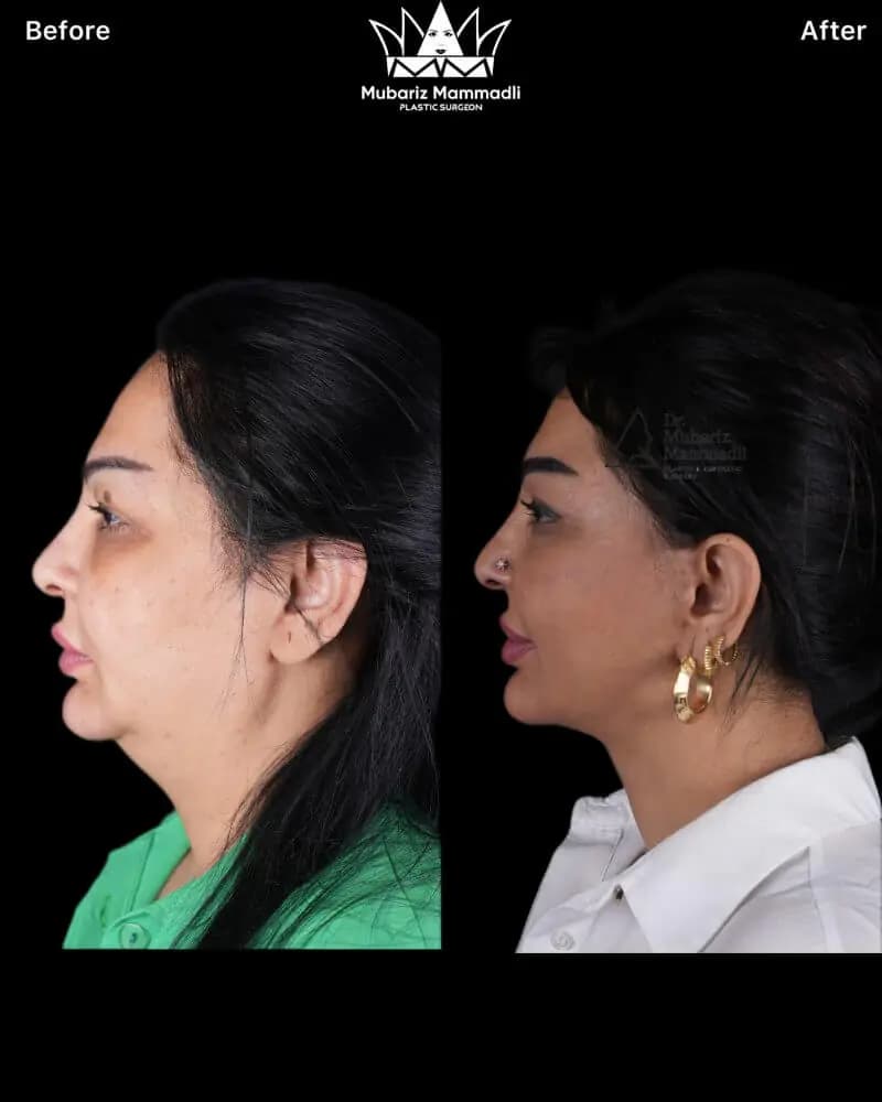 Rezultat inainte si dupa pentru profil si linia mandibulara