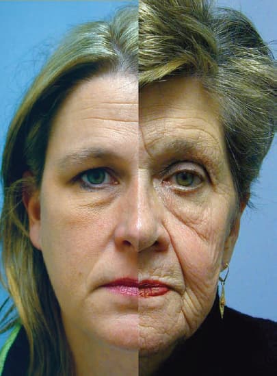 Blepharoplasty Tired Look