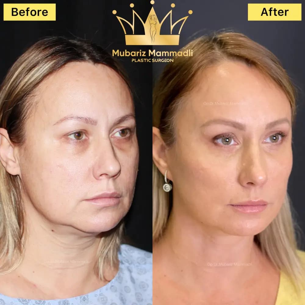 Rezultat inainte si dupa pentru contur facial natural