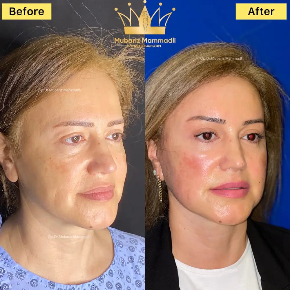Rezultat inainte si dupa pentru rafinarea trasaturilor faciale