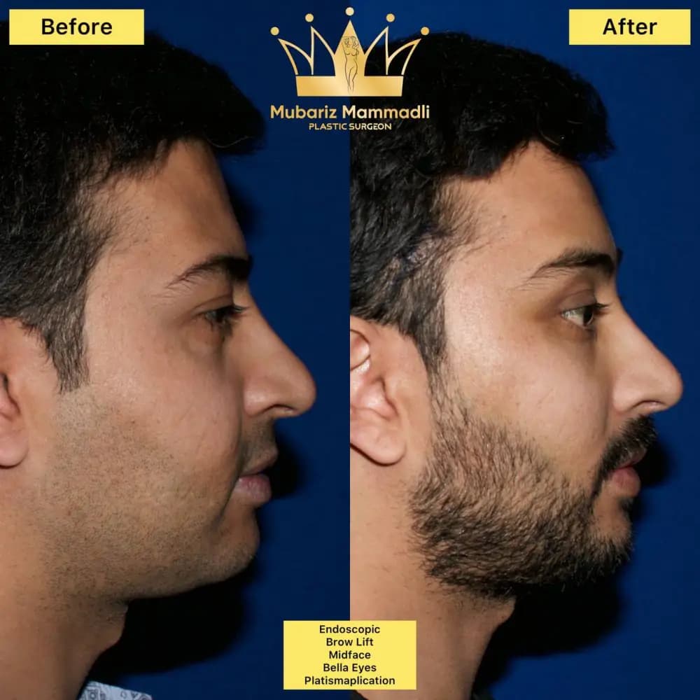 Rezultat inainte si dupa pentru profil facial masculin