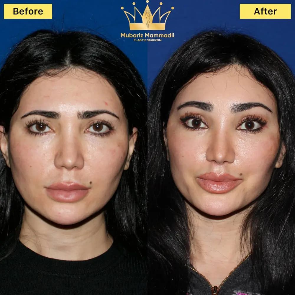 Rezultat inainte si dupa pentru rafinare faciala discreta