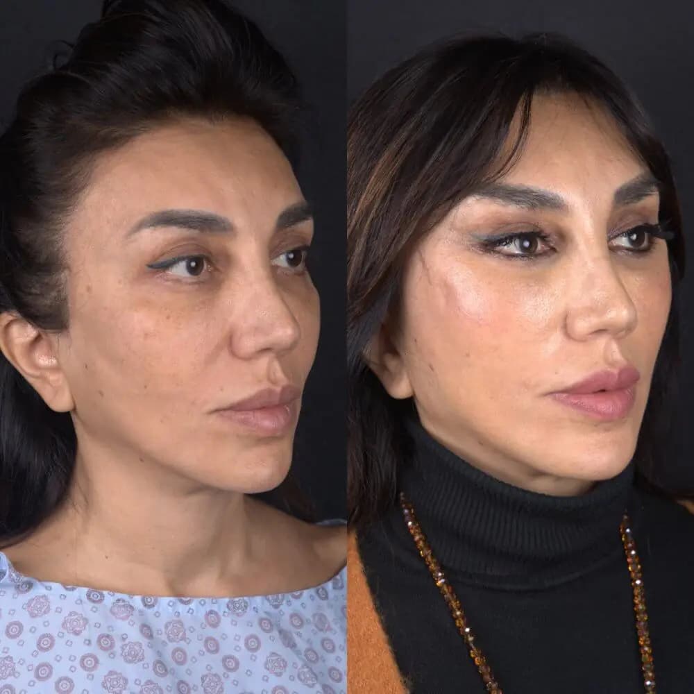 Rezultat inainte si dupa pentru armonizarea profilului facial