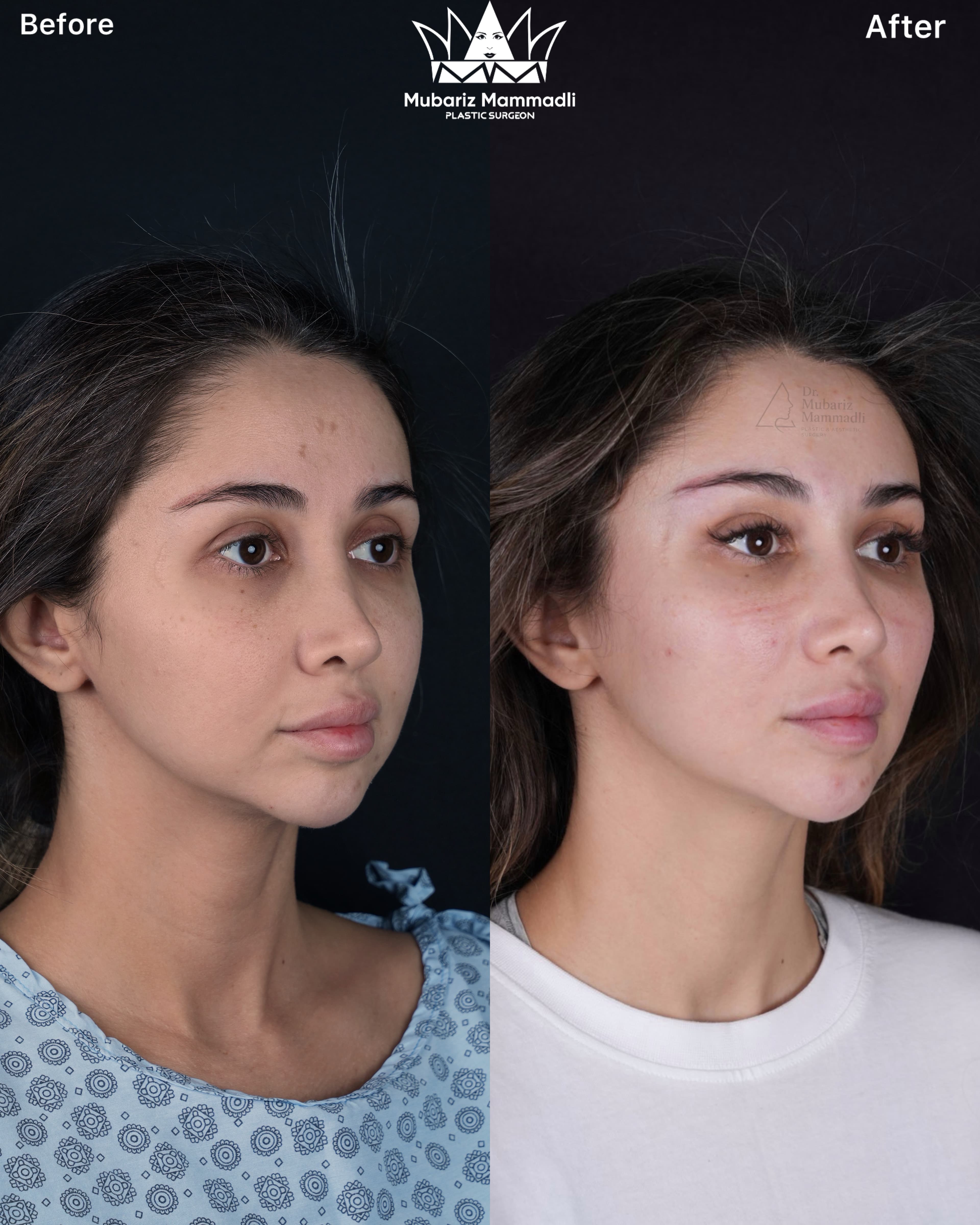 alt= “Endoscopic Midface lift”