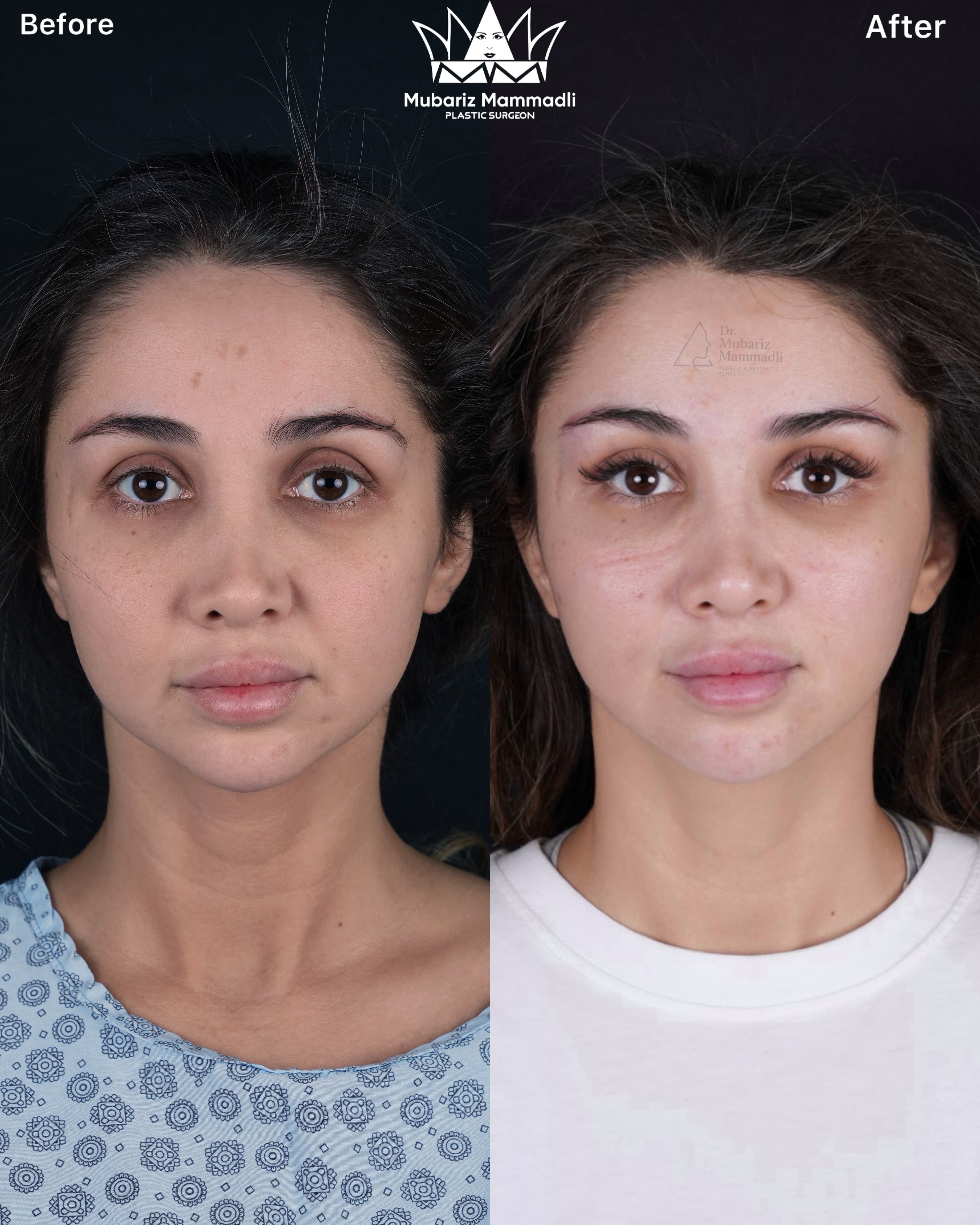 alt= “Deep plane face lift”