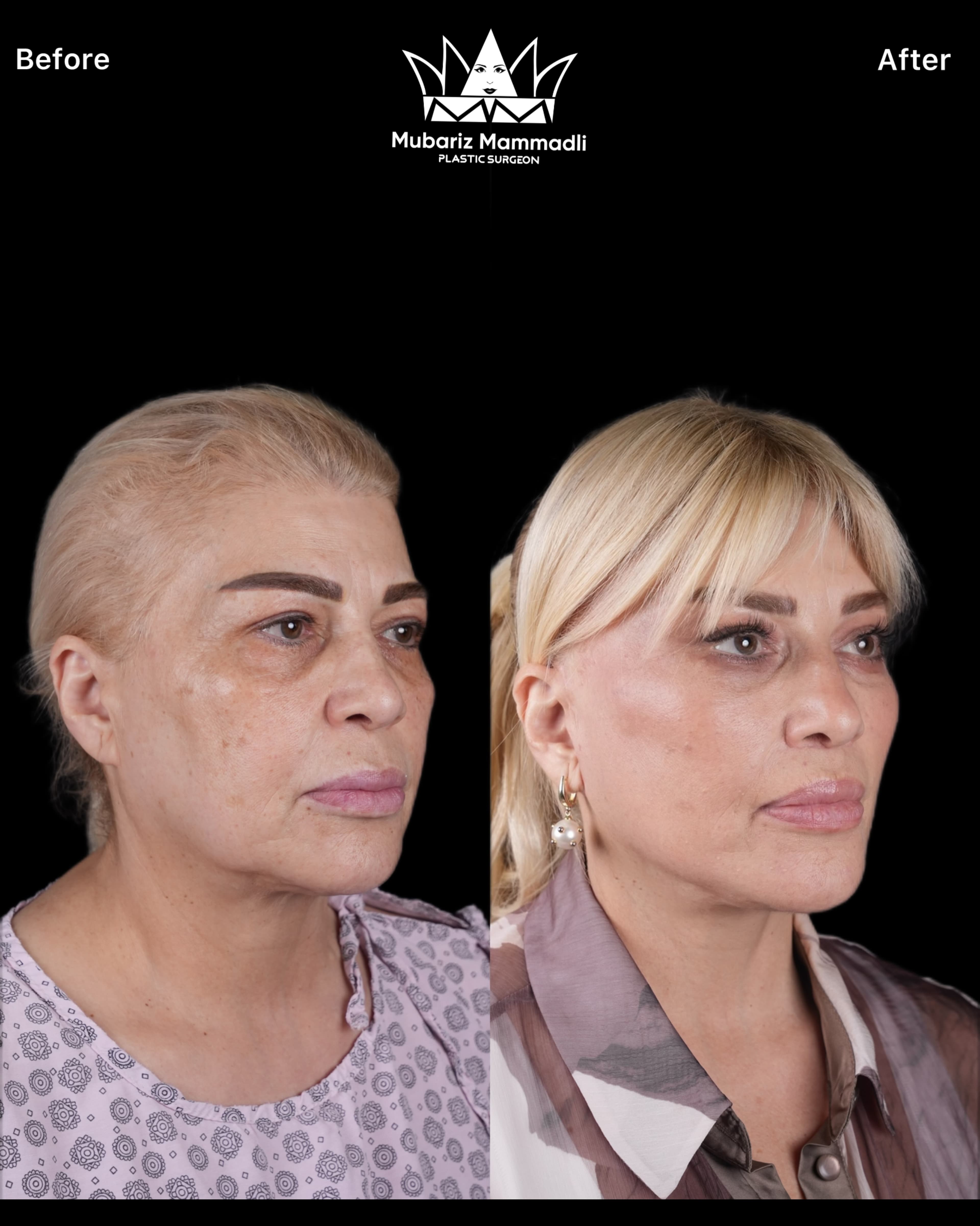 alt= “ deep plane face lift Natural result”