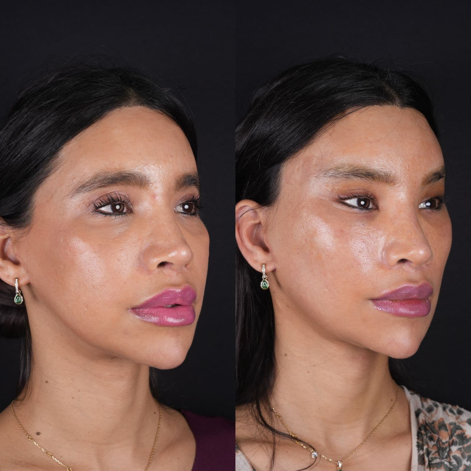 Alt=“endoscopic Midface lift”