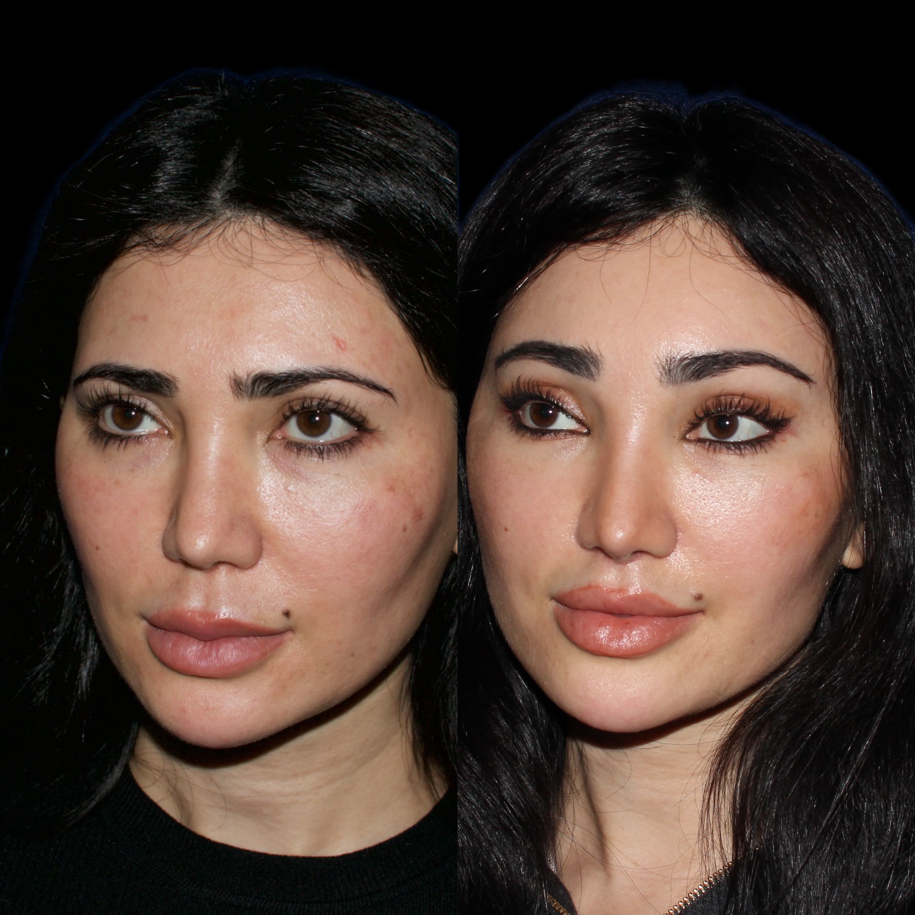 alt="brow lift"