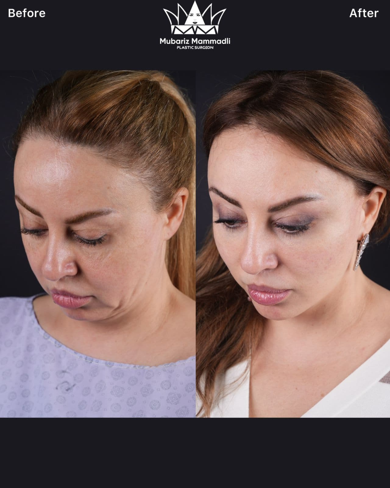 Alt=“facelift Cost”