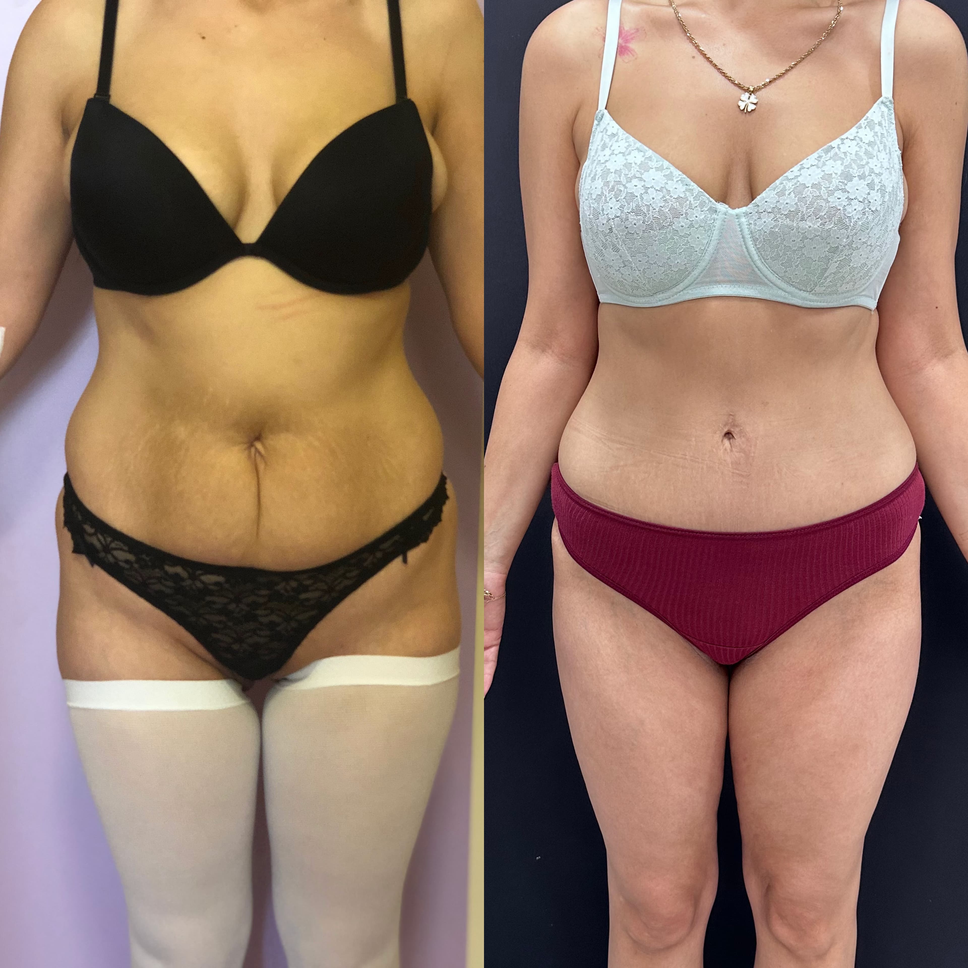 Alt=‘abdominoplasty”