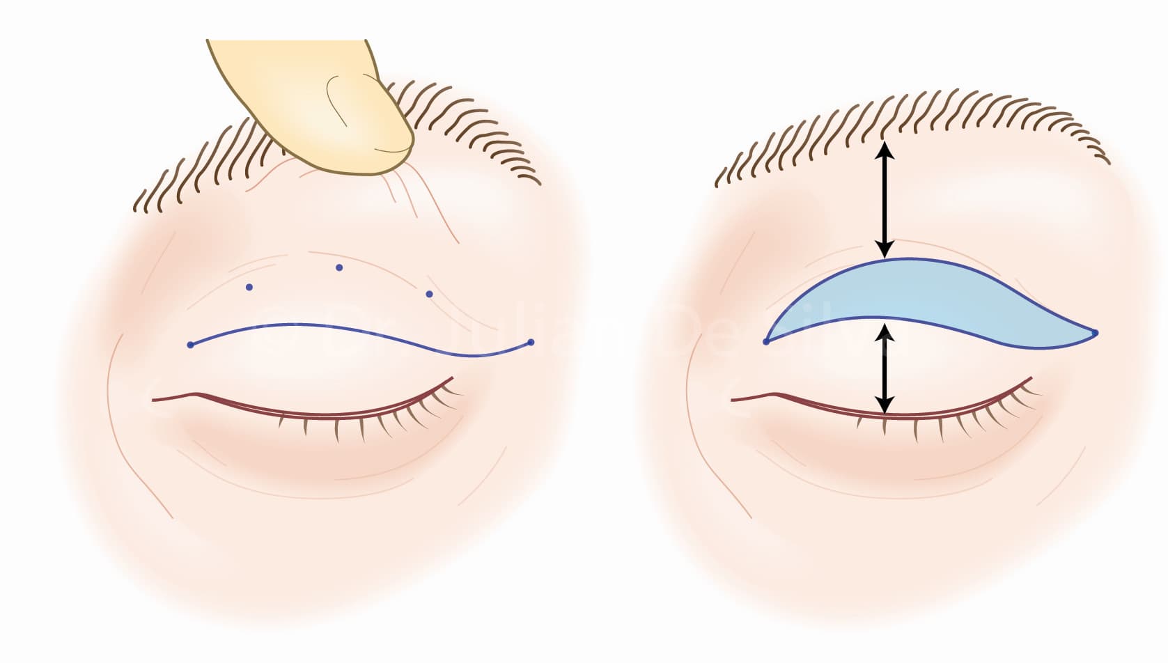 Blepharoplasty Recovery