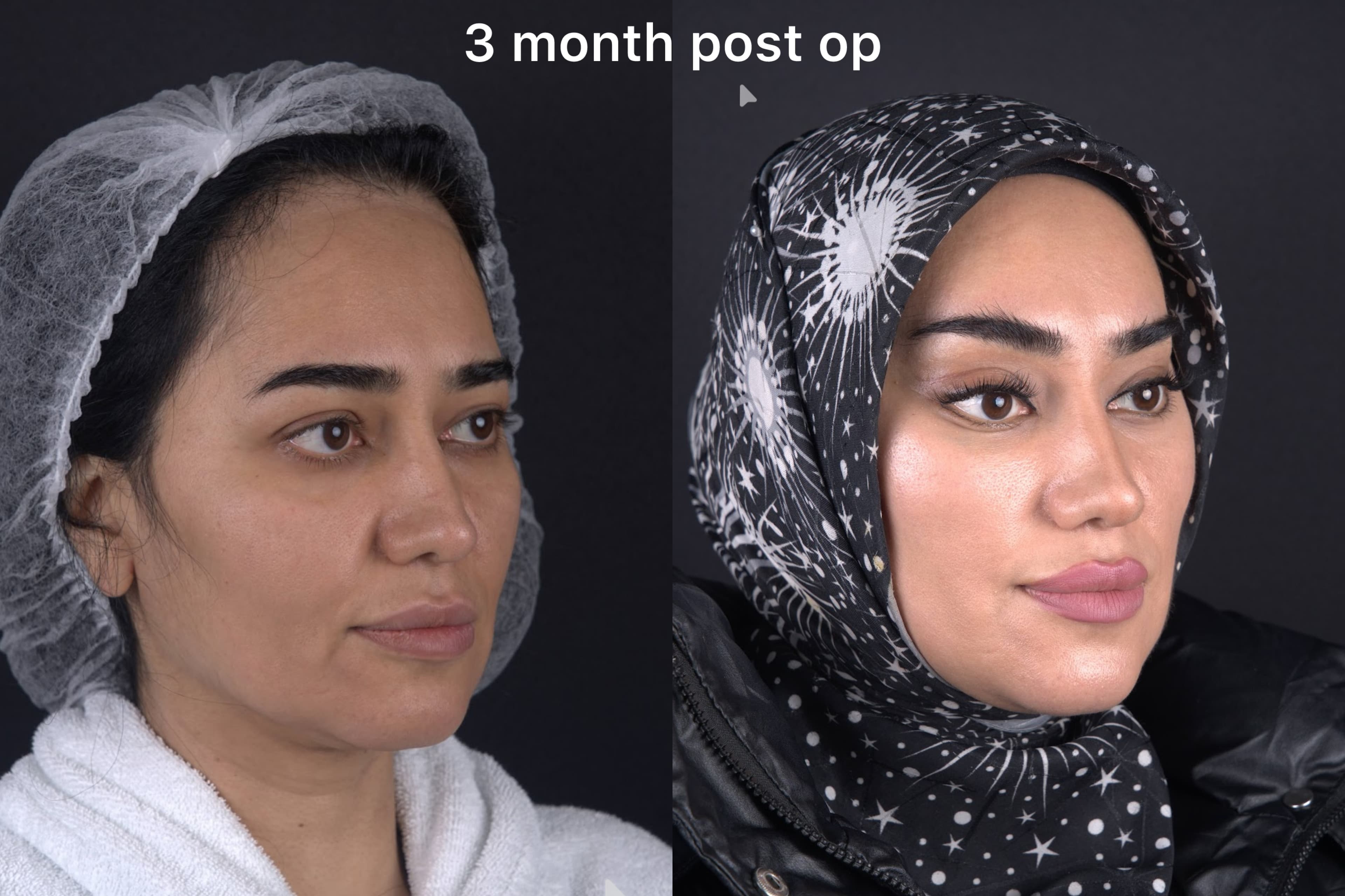 Blepharoplasty Rested Appearance