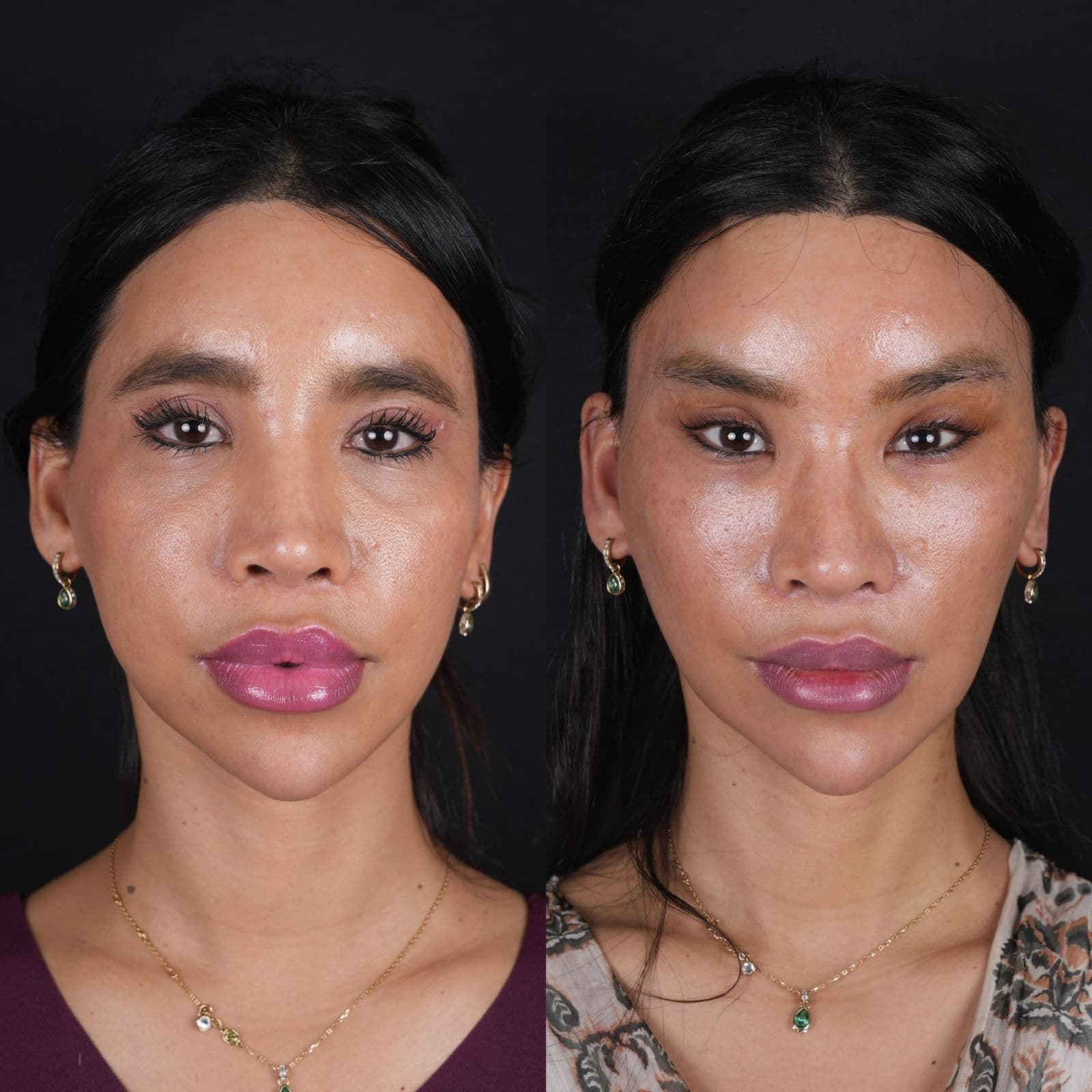 Cât Costă un Facelift