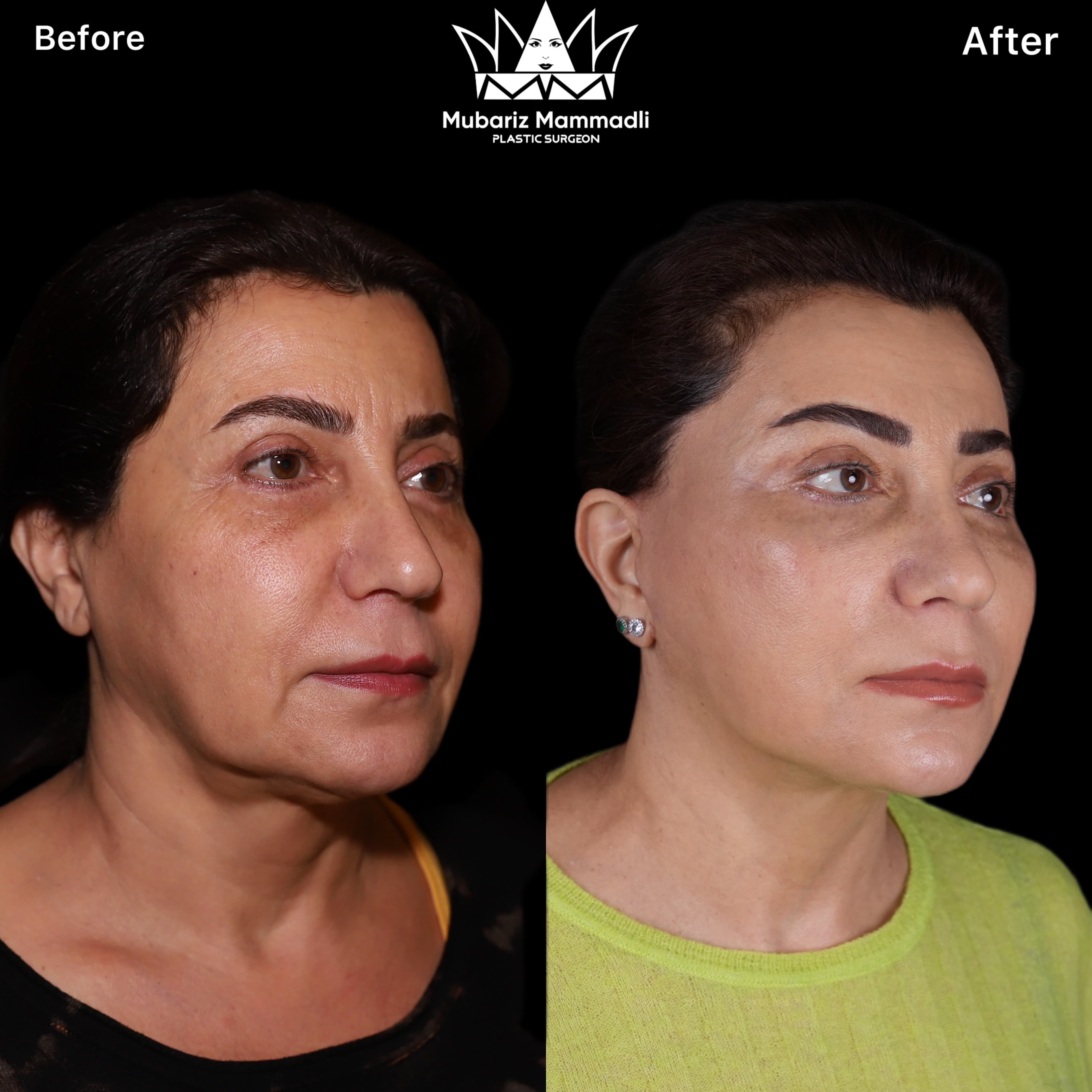 Deep Plane Facelift