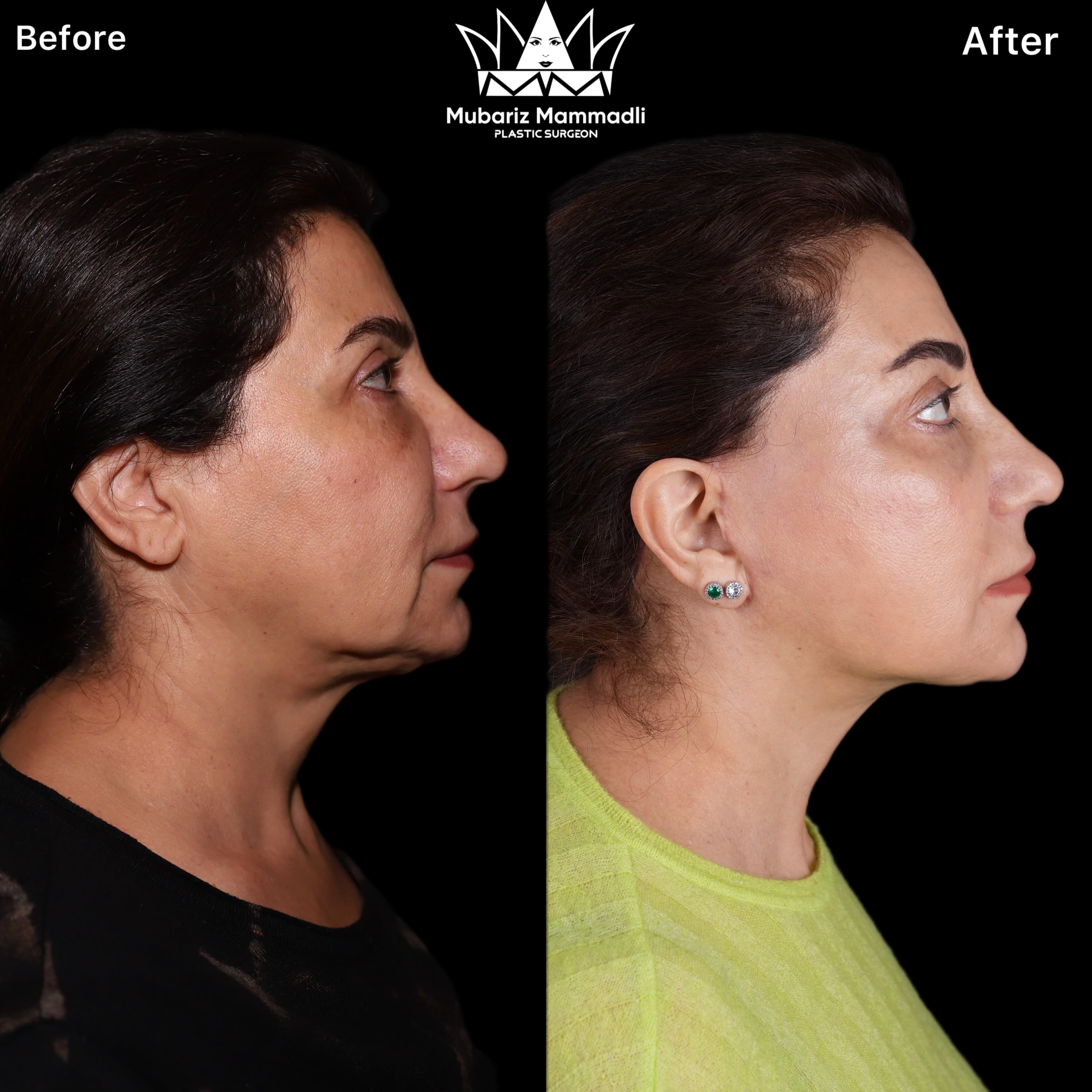 Deep Plane Facelift