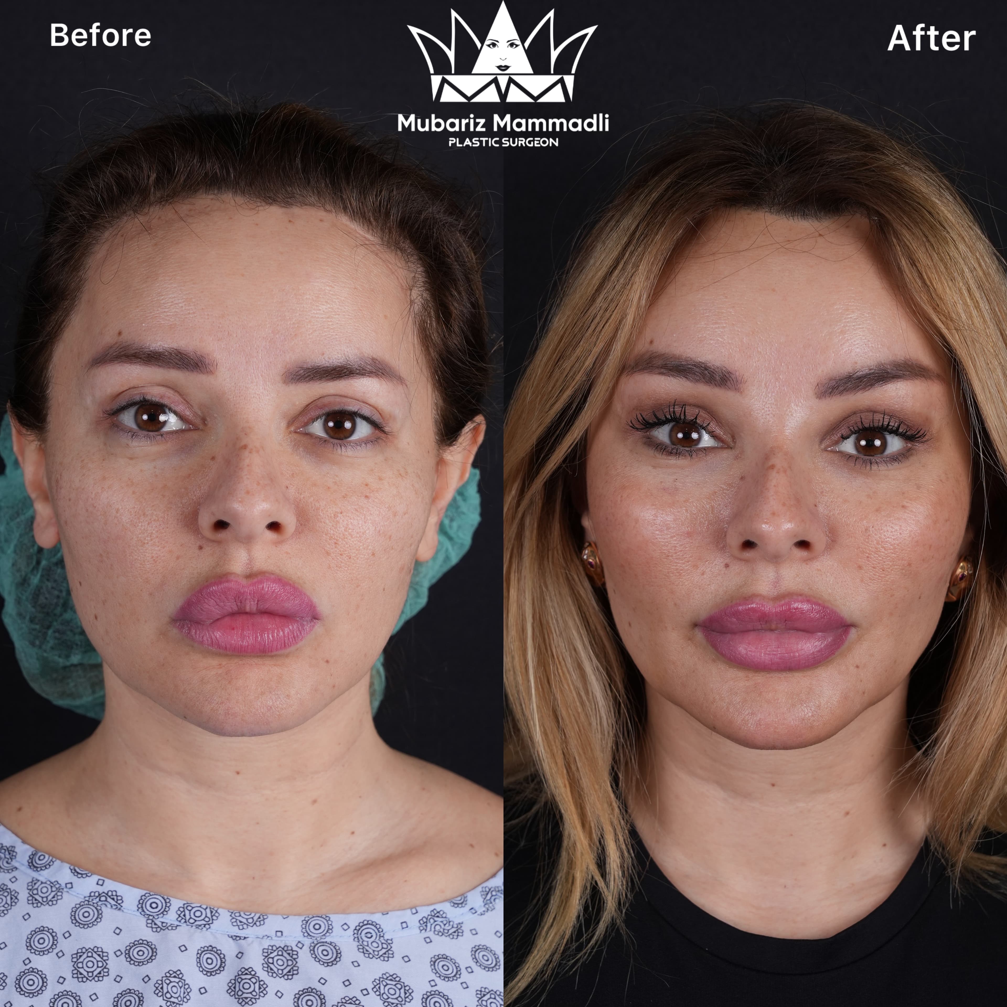 endoscopic brow lift