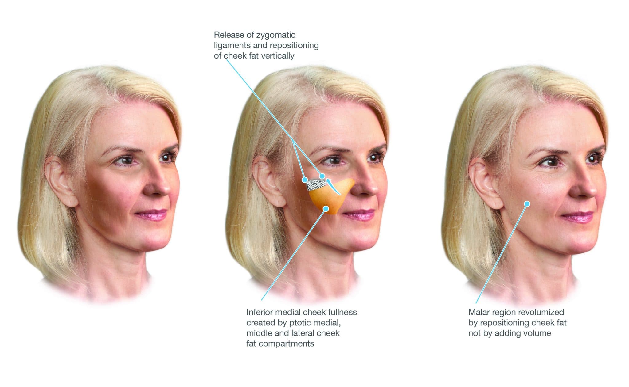 Erholung Deep Plane Facelift